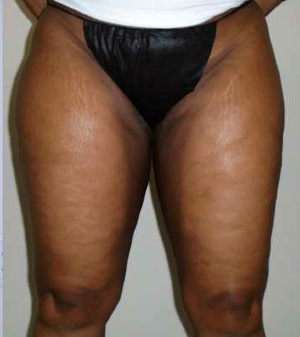 Inner Thigh Before & After Patient #326