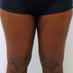 Inner Thigh Before & After Patient #329