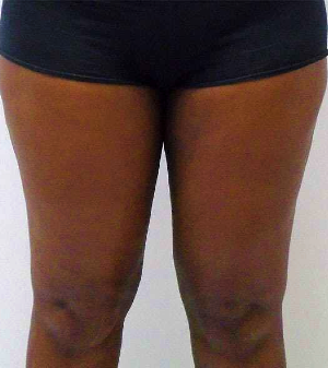 Inner Thigh Before & After Patient #329