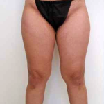 Inner Thigh Before & After Patient #314