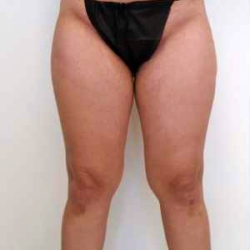 Inner Thigh Before & After Patient #314