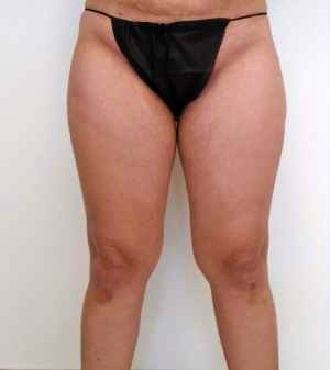 Inner Thigh Before & After Patient #314