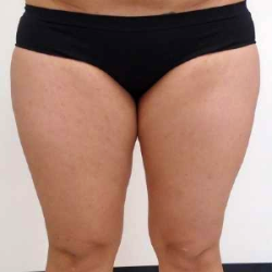 Inner Thigh Before & After Patient #317