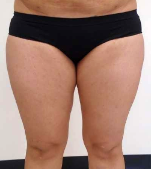 Inner Thigh Before & After Patient #317