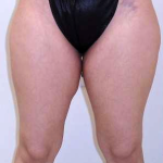 Inner Thigh Before & After Patient #320