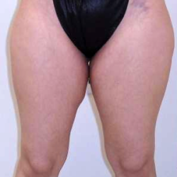 Inner Thigh Before & After Patient #320