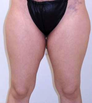 Inner Thigh Before & After Patient #320