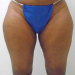 Inner Thigh Before & After Patient #323