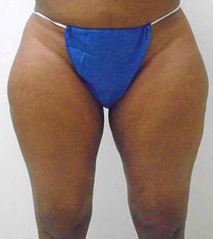 Inner Thigh Before & After Patient #323