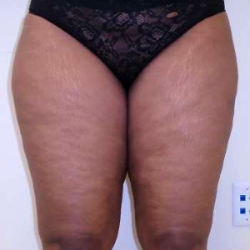 Inner Thigh Before & After Patient #326