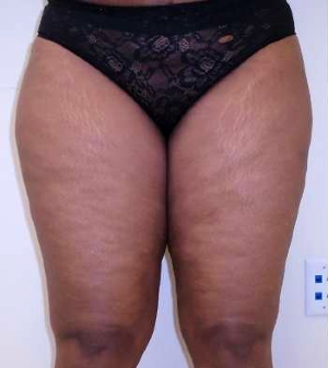 Inner Thigh Before & After Patient #326