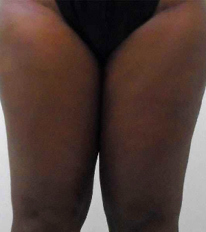 Inner Thigh Before & After Patient #329