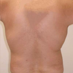 Liposuction Before & After Patient #332
