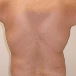Liposuction Before & After Patient #332