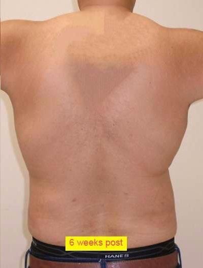 Liposuction Before & After Patient #332