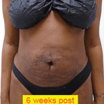 Liposuction Before & After Patient #359