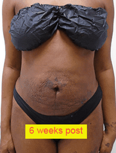 Liposuction Before & After Patient #359
