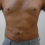 Liposuction Before & After Patient #335