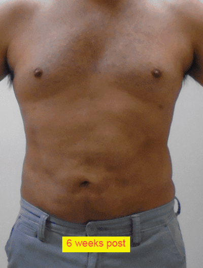 Liposuction Before & After Patient #335