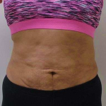 Liposuction Before & After Patient #338