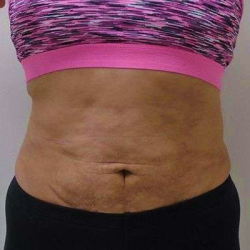 Liposuction Before & After Patient #338