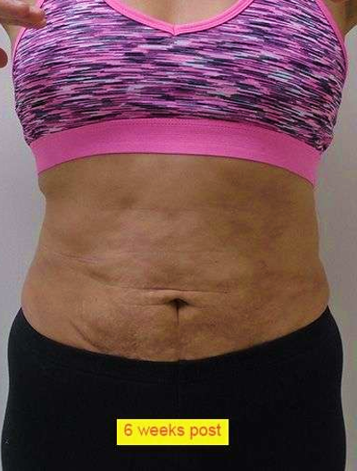 Liposuction Before & After Patient #338