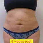 Liposuction Before & After Patient #341