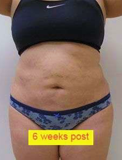 Liposuction Before & After Patient #341