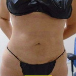 Liposuction Before & After Patient #344