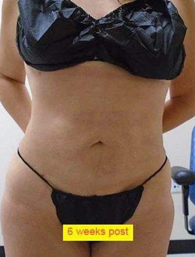 Liposuction Before & After Patient #344