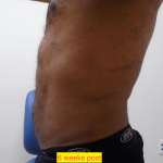 Liposuction Before & After Patient #347
