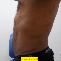 Liposuction Before & After Patient #347