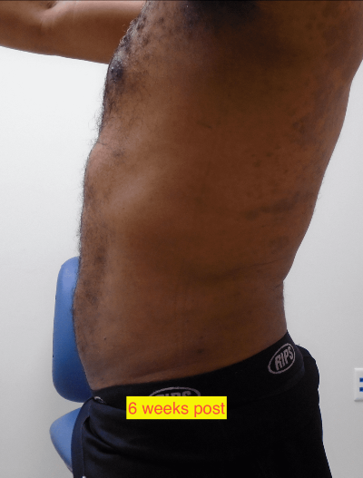 Liposuction Before & After Patient #347