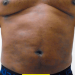 Liposuction Before & After Patient #350