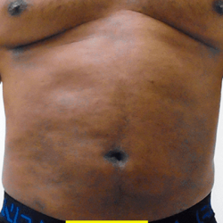 Liposuction Before & After Patient #350