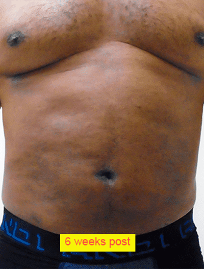 Liposuction Before & After Patient #350