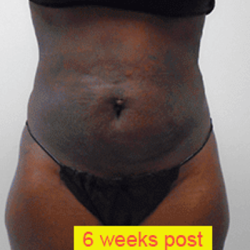 Liposuction Before & After Patient #353
