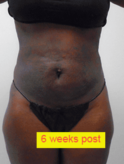 Liposuction Before & After Patient #353