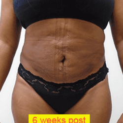 Liposuction Before & After Patient #356