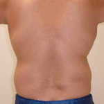Liposuction Before & After Patient #332