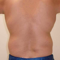 Liposuction Before & After Patient #332