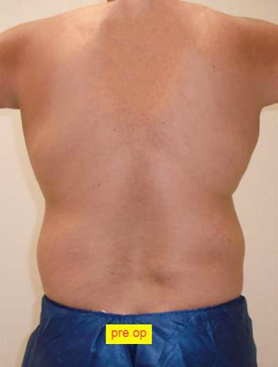 Liposuction Before & After Patient #332