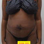 Liposuction Before & After Patient #359