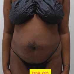 Liposuction Before & After Patient #359