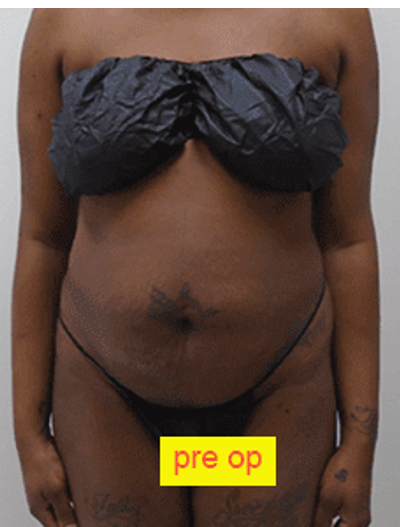 Liposuction Before & After Patient #359