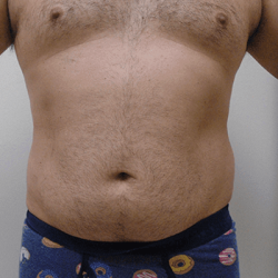 Liposuction Before & After Patient #335