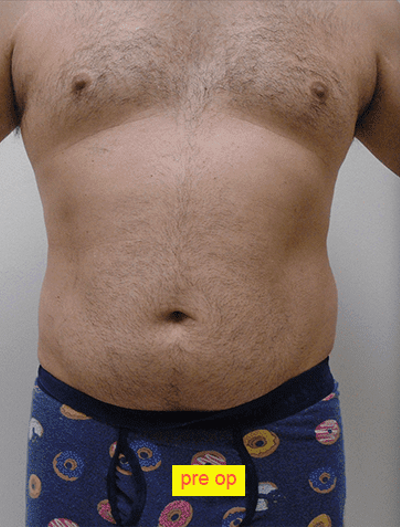 Liposuction Before & After Patient #335