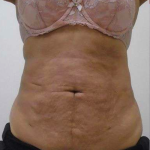 Liposuction Before & After Patient #338