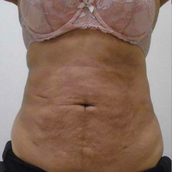 Liposuction Before & After Patient #338