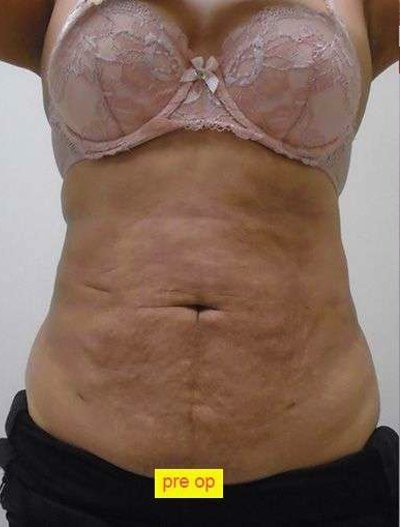 Liposuction Before & After Patient #338